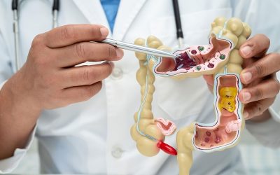 Pólipos en el colon: síntomas y tratamiento | Gastroenterólogo